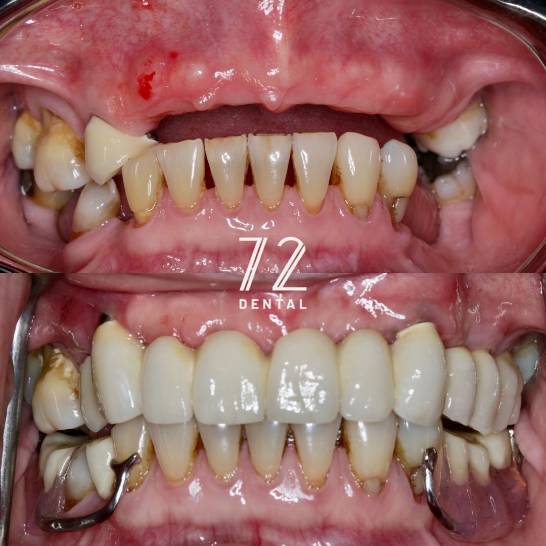 Full-arch All-on-4 dental implants before and after showing a failing upper arch replaced with fixed implant teeth at 72 Dental