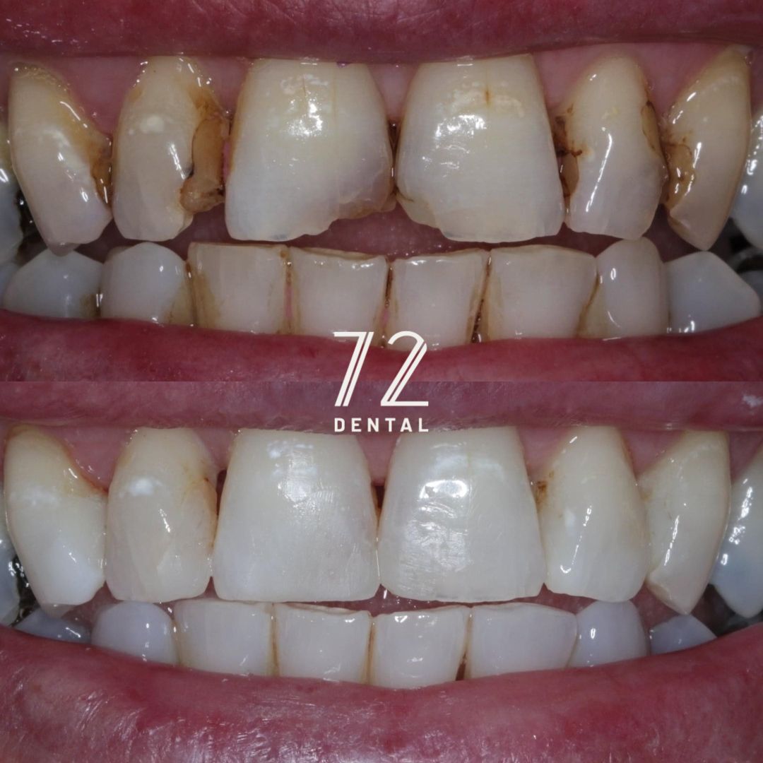 Composite bonding finishing touches after Invisalign teeth straightening