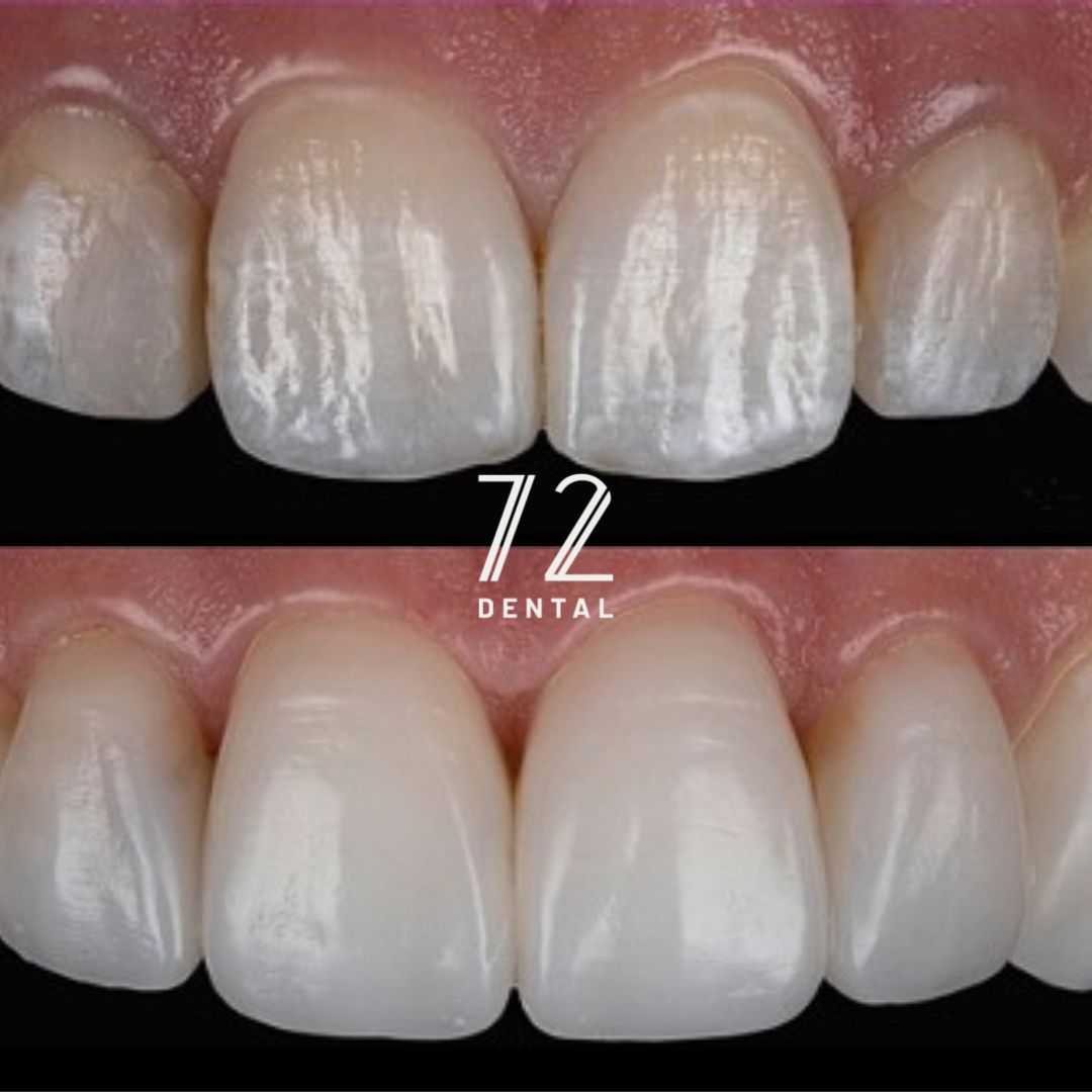 Before and after composite bonding repairing chipped front teeth