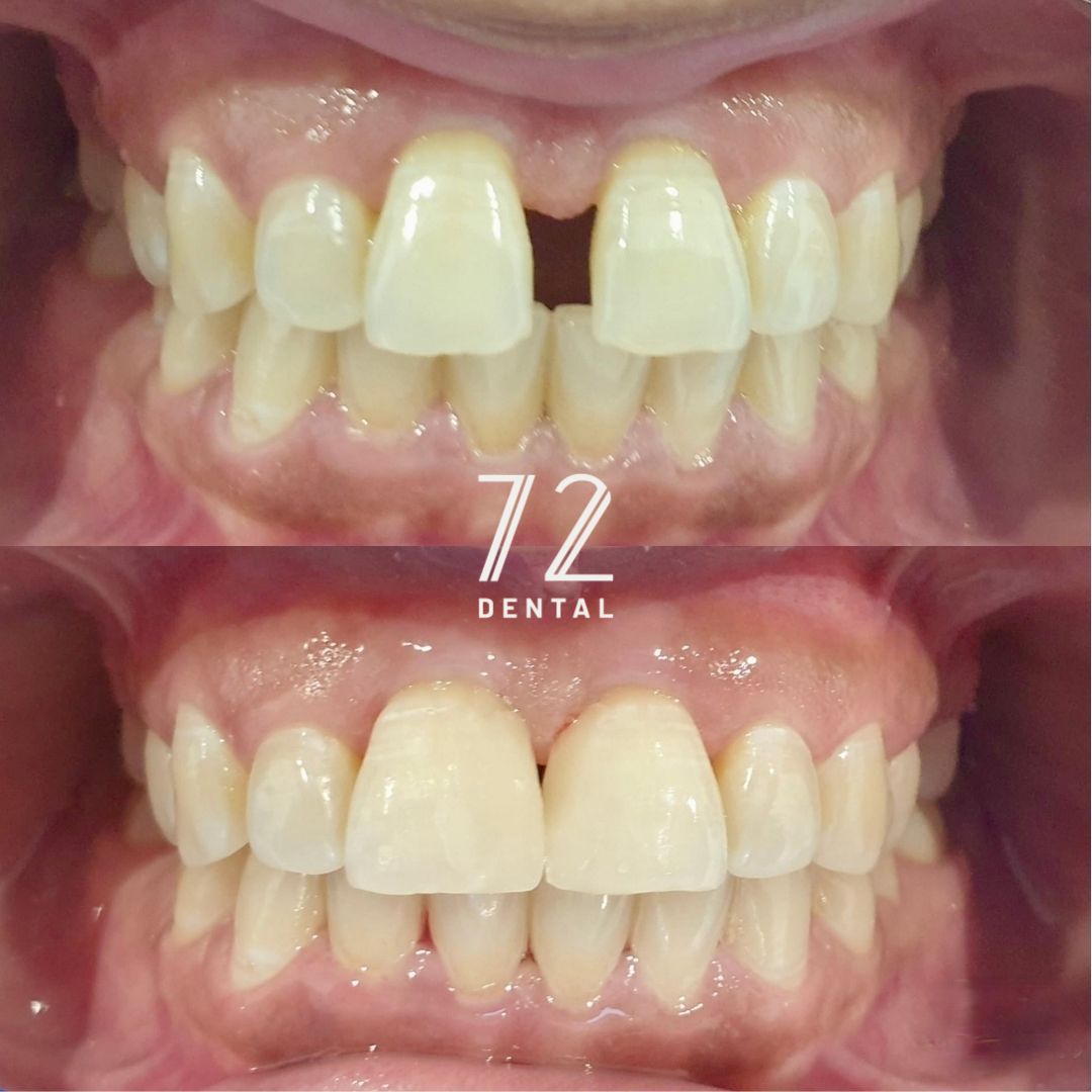Before and after composite bonding improving the colour and shape of front teeth
