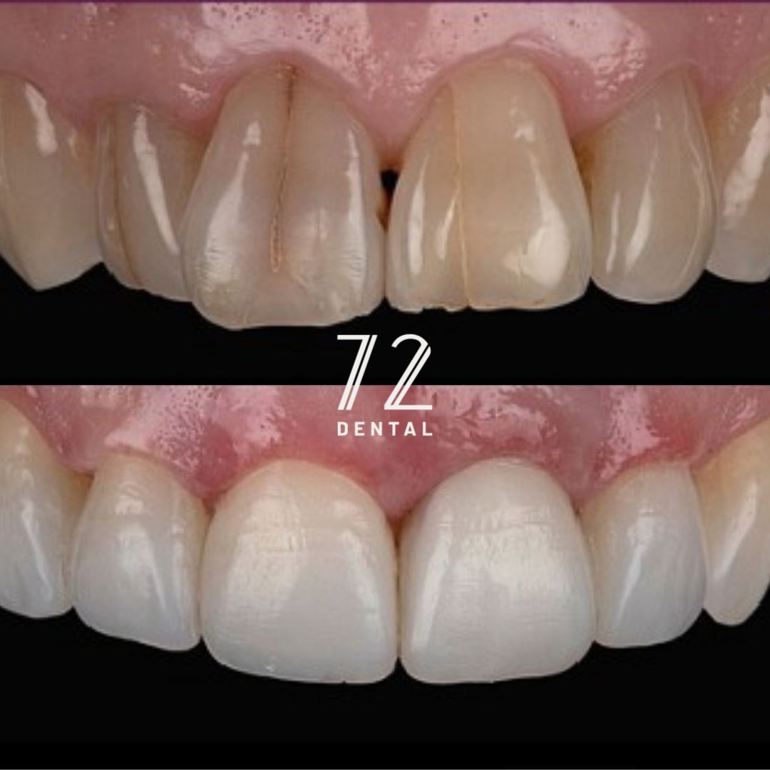 Composite bonding before and after closing a gap between the upper front teeth at 72 Dental Coulsdon