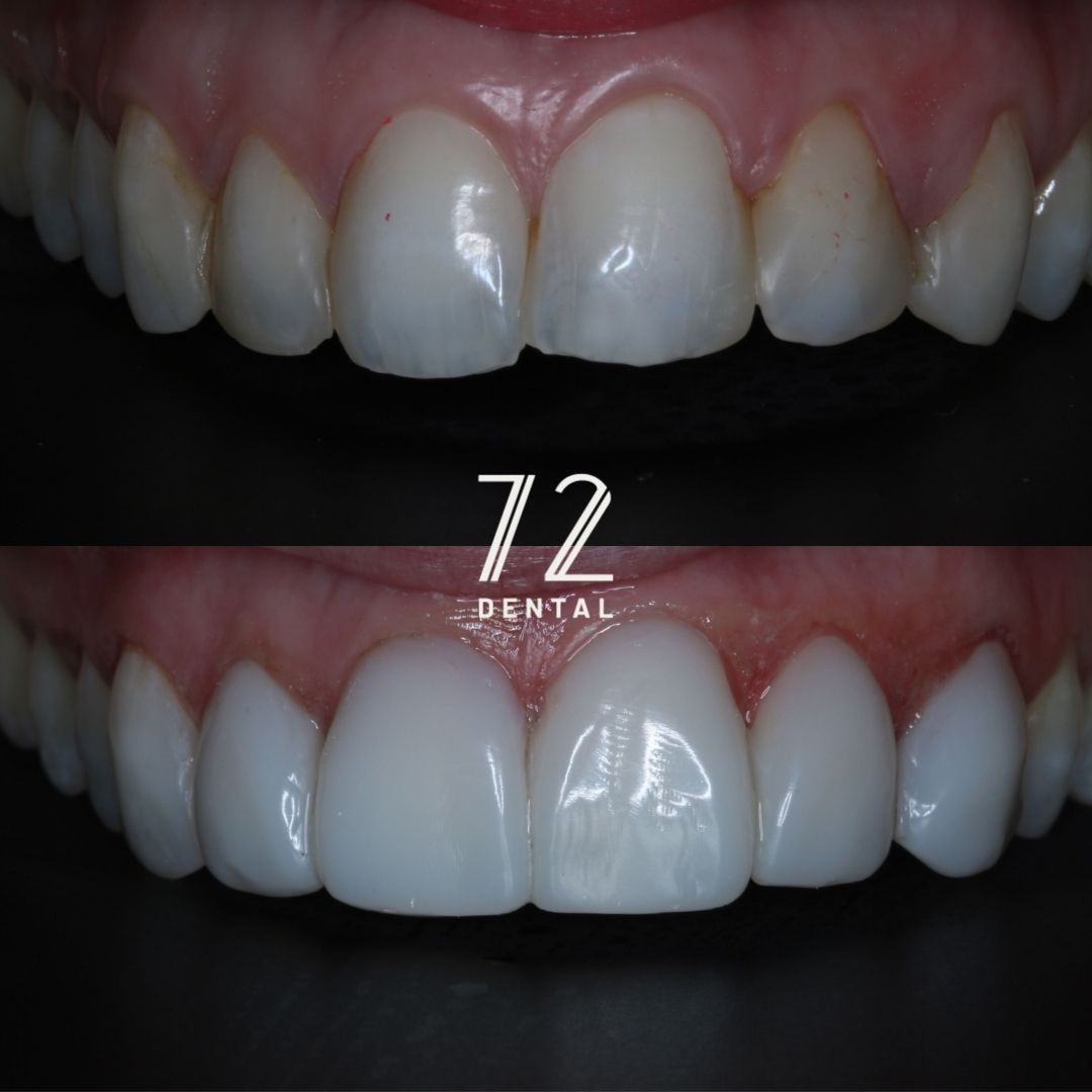 Composite bonding before and after reshaping uneven teeth
