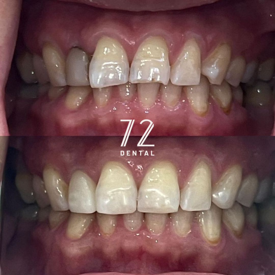 Composite bonding smile makeover before and after on the upper front teeth