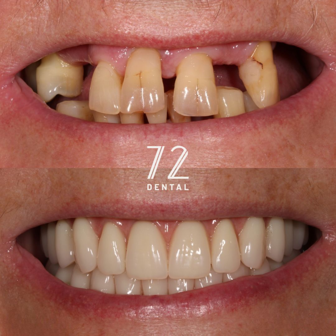 Before and after Smile in a Day treatment at 72 Dental Coulsdon, worn and failing upper teeth replaced with a full fixed arch