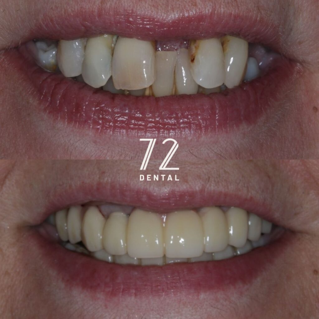 Smile in a Day full-arch dental implants before and after at 72 Dental Coulsdon, upper front teeth restored with a fixed implant bridge