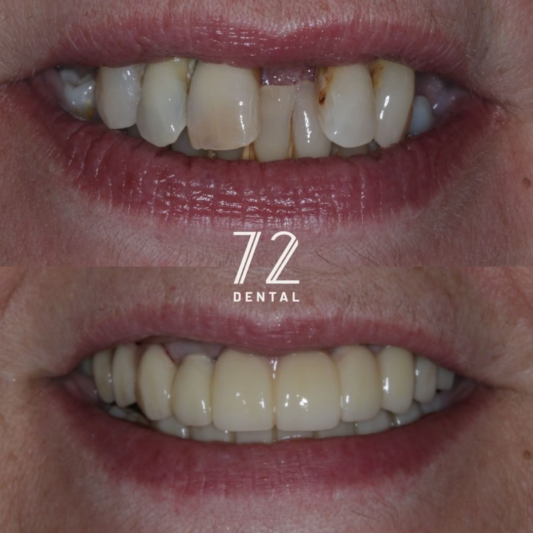 Smile in a Day full-arch dental implants before and after at 72 Dental Coulsdon, upper front teeth restored with a fixed implant bridge